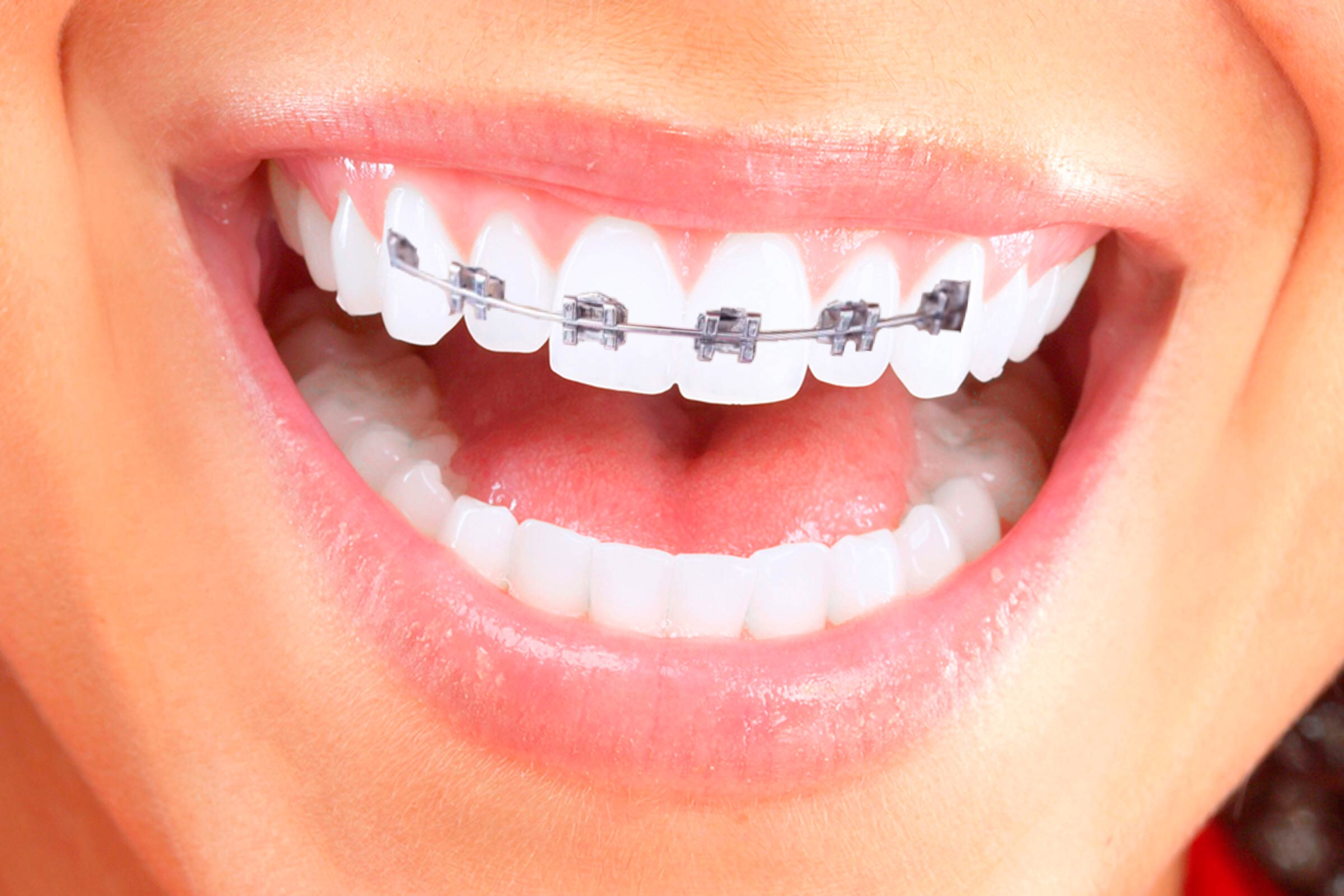 The Best Teeth Whitening Methods Re-Evaluated!